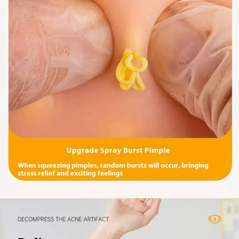Squeeze Blackhead Toy – Relaxing Acne Simulation for Stress Relief