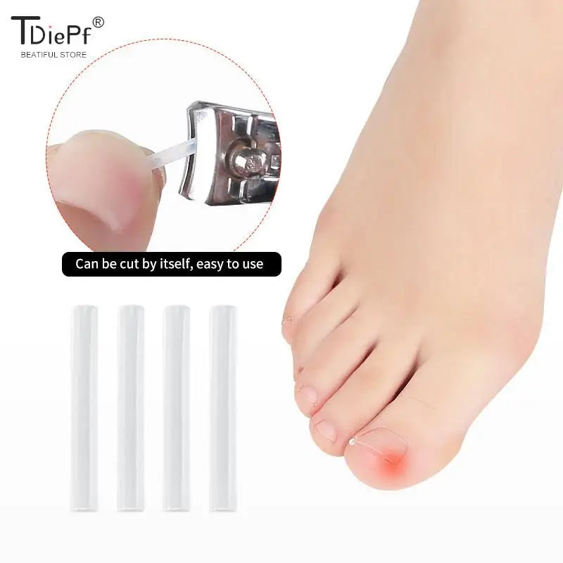 50Pcs Ingrown Toenail Correction