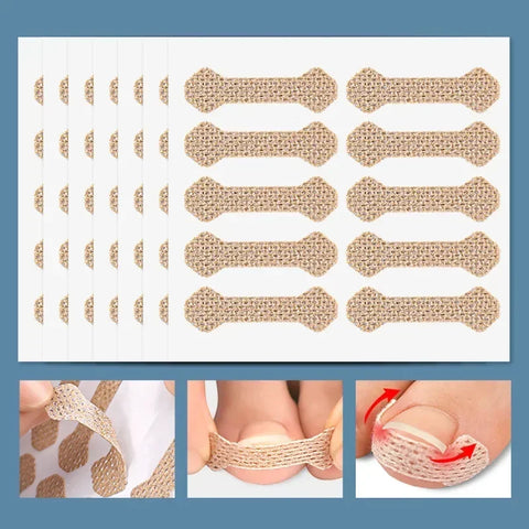 Toenail Correction Stickers – Painless Ingrown Nail Care Strips
