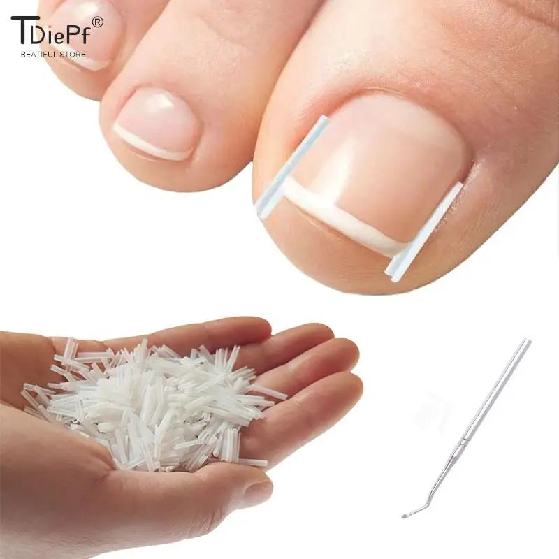 50Pcs Ingrown Toenail Correction