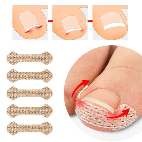 Toenail Correction Stickers – Painless Ingrown Nail Care Strips